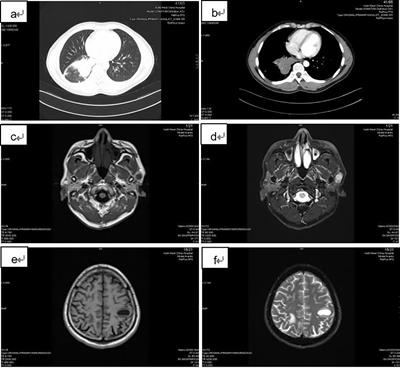 Parotid metastases from primary lung cancer: Case series and systematic review of the features